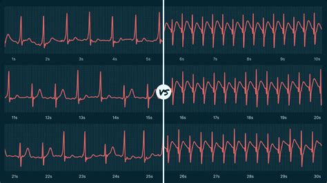 Wolff-Parkinson-White Syndrome Vs. Supraventricular Tachycardia (Sustained) on Your Watch ECG | Qaly