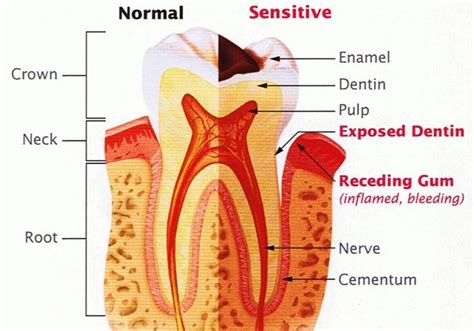 Tooth sensitivity (dentin hypersensitivity) | The Sunday News