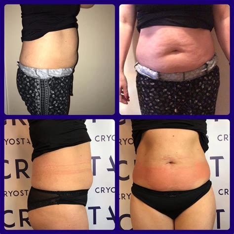 Fat Freezing before & after pictures with Cryostar's amazing technology