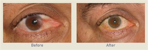 Pterygium Removal | Before & After Photo Gallery | Los Angeles