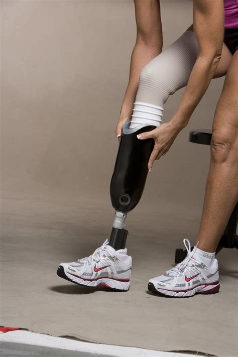 Artificial Leg Fitting | Below the knee amputation, Orthotics, Legs