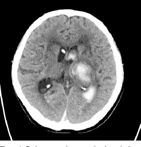 Figure 1 from Pusher syndrome improved by secondary newly developed ...