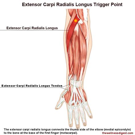 Extensor Carpi Radialis Longus Muscle Pain - The Wellness Digest