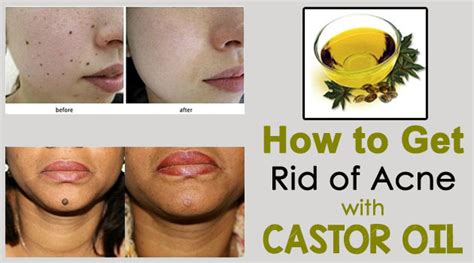 How to Get Rid of Acne with Castor Oil - Getinfopedia.com