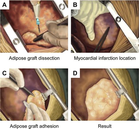 Schematic illustration of the Adipose Graft Transposition Procedure... | Download Scientific Diagram