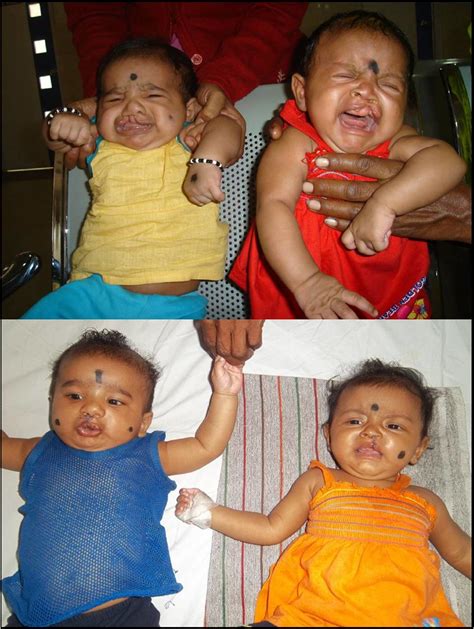 Cleft Lip Children | Cleft Lip Children - "Transforming Live… | Flickr