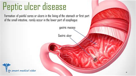 Peptic Ulcer symptoms,signs, investigations and complications ~ Med2Date