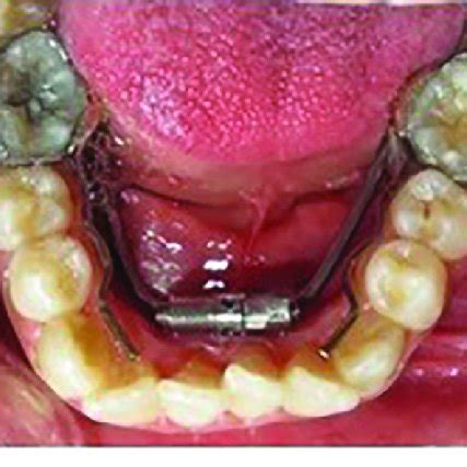 (a) Quad helix maxillary expander used in the study; (b) Hyrax ...