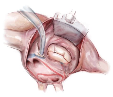 Minimally Invasive Atrial Fibrillation Surgery | Dr Andrie Stroebel ...