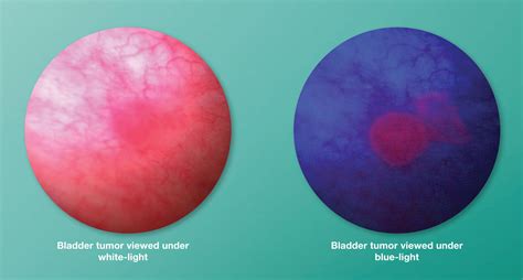 Blue Light Cystoscopy Locations | Shelly Lighting