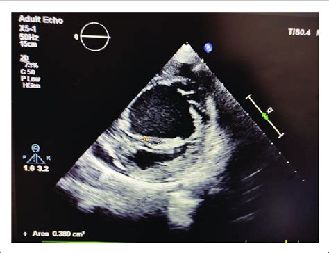 Parasternal Short Axis View Showing Mitral Valve Area to Be 0.4 cm 2 by ...