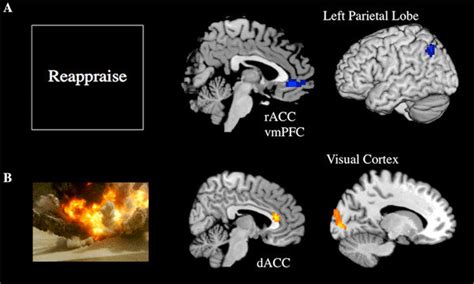 Brain regions showing a significant group (PTSD patients and controls)... | Download Scientific ...