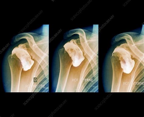 Complications following dislocated shoulder in sports injury - Stock ...