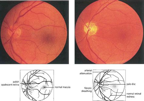 Retinal Degenerations: Retinal Dystrophies | Clinical Gate