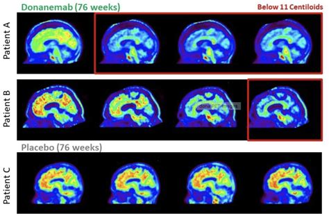 Positive donanemab study results may be 'inflection point for the field'