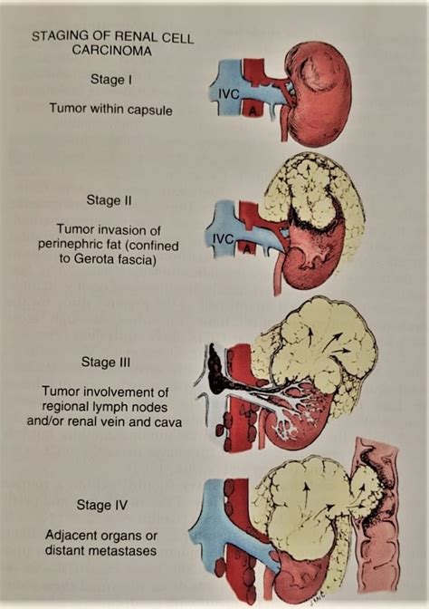 Kidney/Renal Cancer Treatment/Nephrectomy Surgery in Navi Mumbai