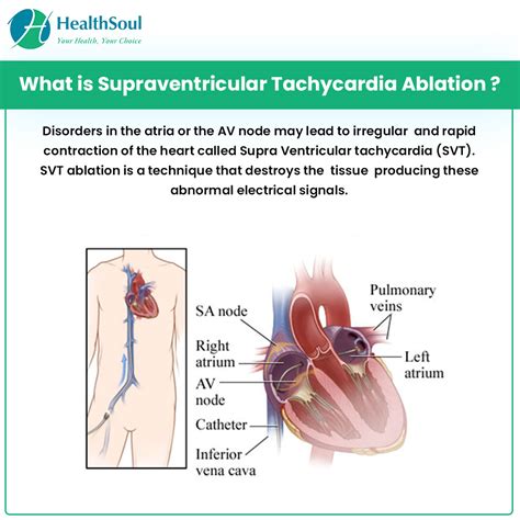 Supraventricular Tachycardia Ablation: Indications and Complications – Healthsoul