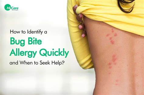 10 Symptoms of Bug Bite Allergy and How To Treat Them Quickly