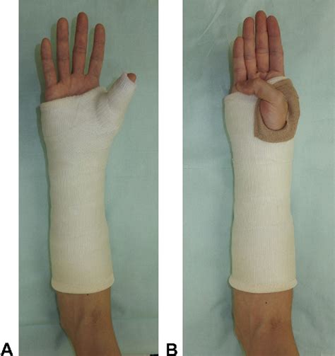 In Vivo Scaphoid Motion During Thumb and Forearm Motion in Casts for ...