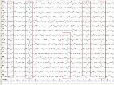 Triphasic waves eeg - acetocellphone