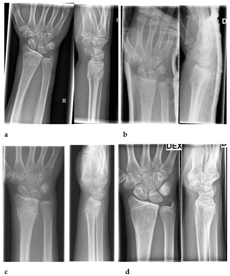 Clinical Follow-Up without Radiographs Is Sufficient after Most ...