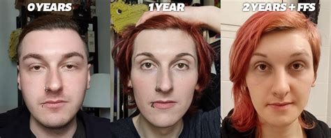 MTF: Start of Transition - 1 Year on Hormones - 2 Years on Hormones ...