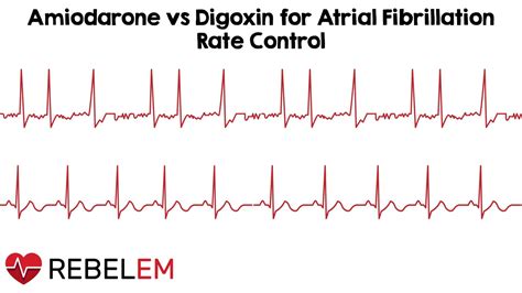 Atrial Fibrillation With Rvr