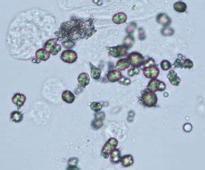 Types of Crystals in Urine - Laboratory Insider