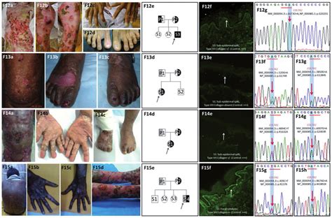 Phenotype and genotype spectrum of recessive dystrophic epidermolysis... | Download Scientific ...