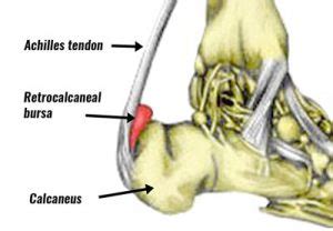 Achilles Bursitis | Retrocalcaneal Bursitis - Symptoms, Causes & Treatment