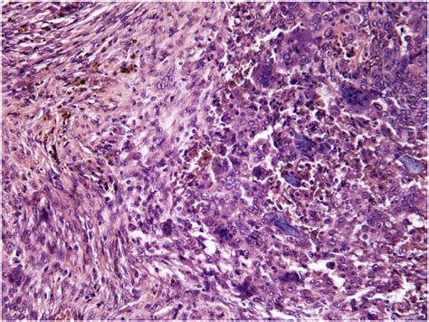 A micrograph shows osteoclast-like multinucleated giant cells and... | Download Scientific Diagram