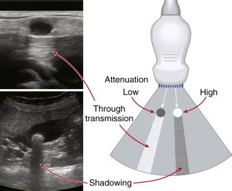 Ultrasound Artifacts | Radiology Key