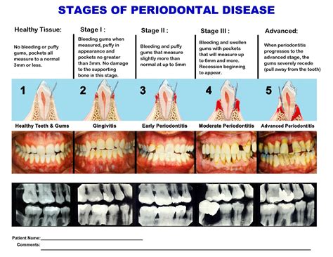 Periodontal Disease-Dr. Daniel R. Pestana Diamond Certified