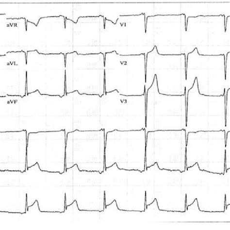 (PDF) Coronary Vasospasm in an Adolescent Resulting from Marijuana Use