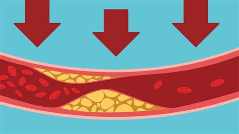 Twice Yearly Injections Halve Bad Cholesterol in Patients With Clogged Arteries, Study Shows