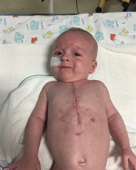 CHD babies in Australia show scars from surgery | Daily Mail Online