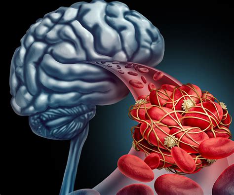 Stroke Stem Cell Treatment in Delhi, India | Stem Cell Therapy for Stroke