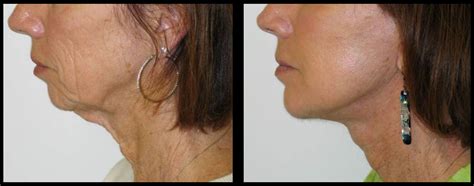 A Reason to Be Thankful: Turkey Neck Treatments that Work - California ...