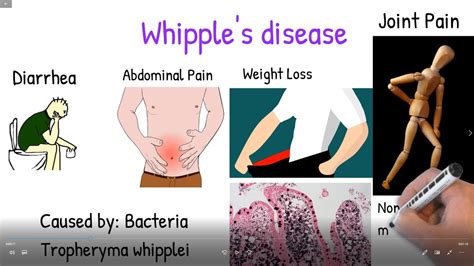 Whipple's disease made easy. Whipple disease symptoms, treatment ...