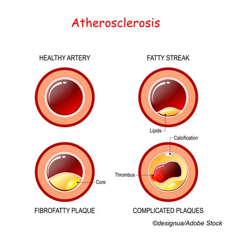 The Case Against Coronary Artery Calcium Scoring for Cardiovascular Disease Risk Assessment ...