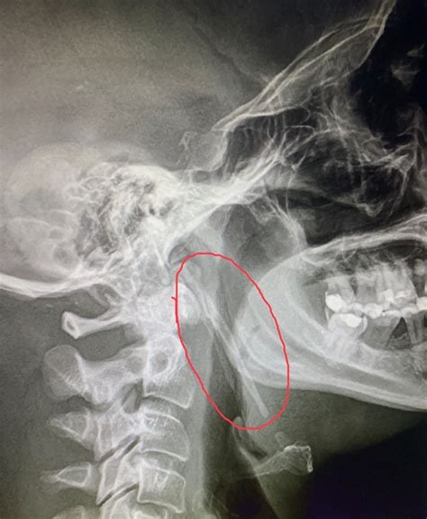 Bilateral Eagle Syndrome - Dominik S. Dabrowski, Ghali E. Ghali, James D. Cotelingam, 2022