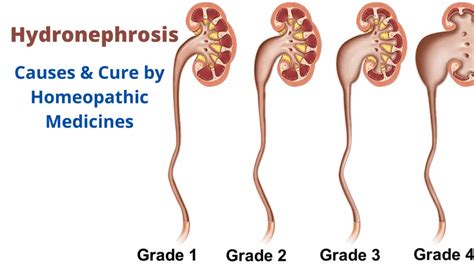 Hydronephrosis - Causes & Best Homeopathic Medicines