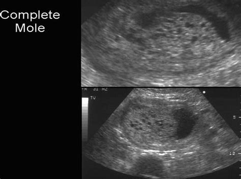 Ultrasound of Complete Molar Pregnancy