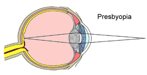 Presbyopia: Signs, Causes, Treatment and Prevention