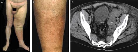 Relapse of primary extranodal marginal-zone B-cell lymphoma of the dura mater - The Lancet Oncology