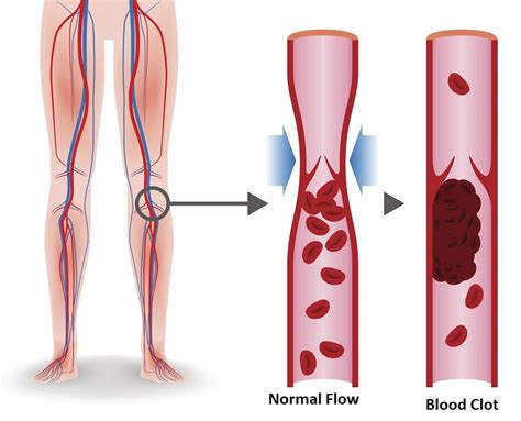 Signs and Symptoms Of A Blood Clot - Health BeatHealth Beat