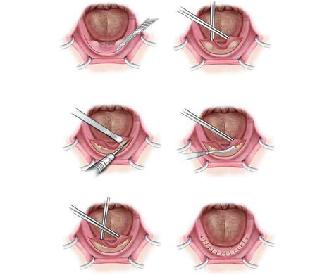 Torus Mandibularis Removal