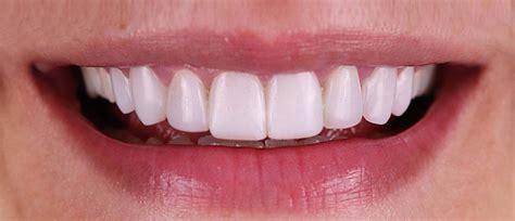 Emax Veneers London: Enhance Dental Aesthetics with E-max Veneers