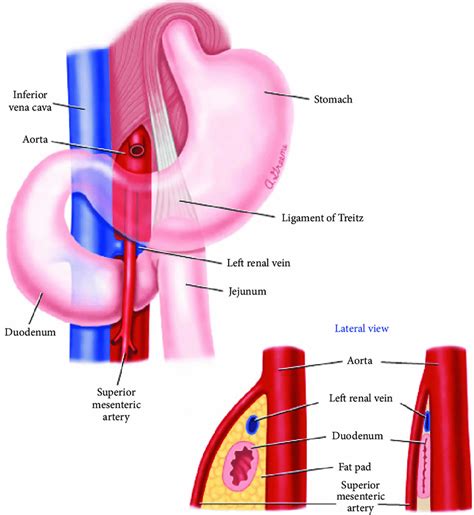 SMA syndrome causes, symptoms, diagnosis, treatment & prognosis