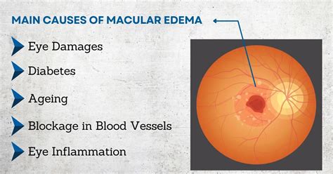 Cystoid Macular Edema (CME) Treatment in Delhi | Causes & Prevention